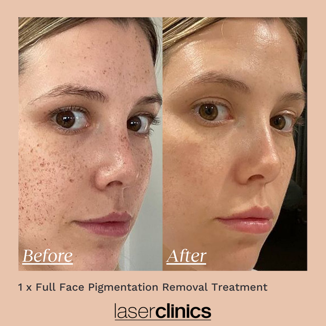 Pigmentation B&A 3.png
