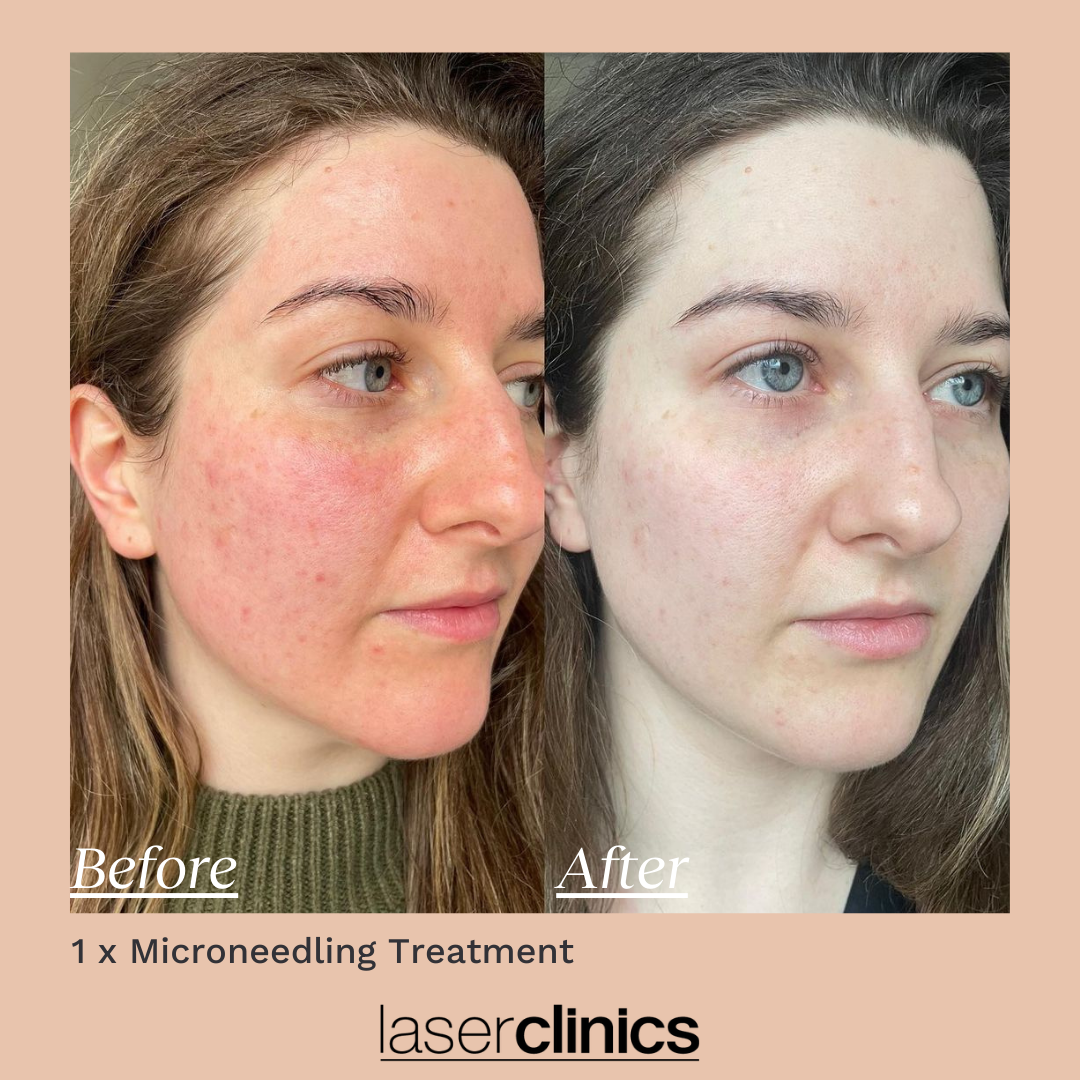 Microneedling B&A 2.png