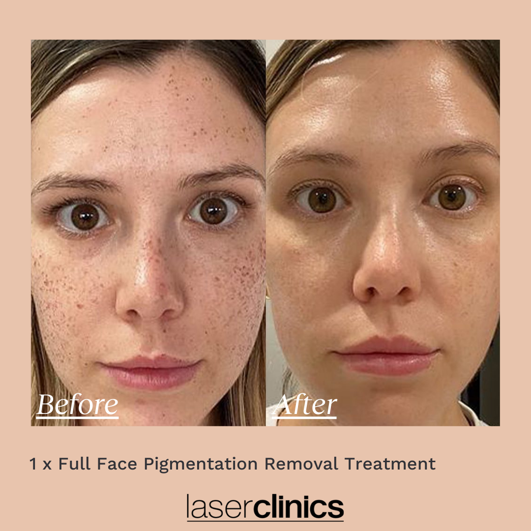 Pigmentation B&A 2.png