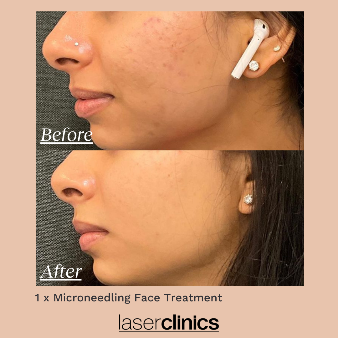 Microneedling B&A 1.png