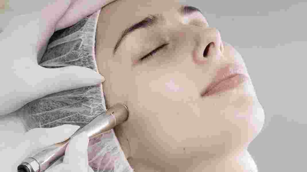 15 Impressive Facts about Microdermabrasion