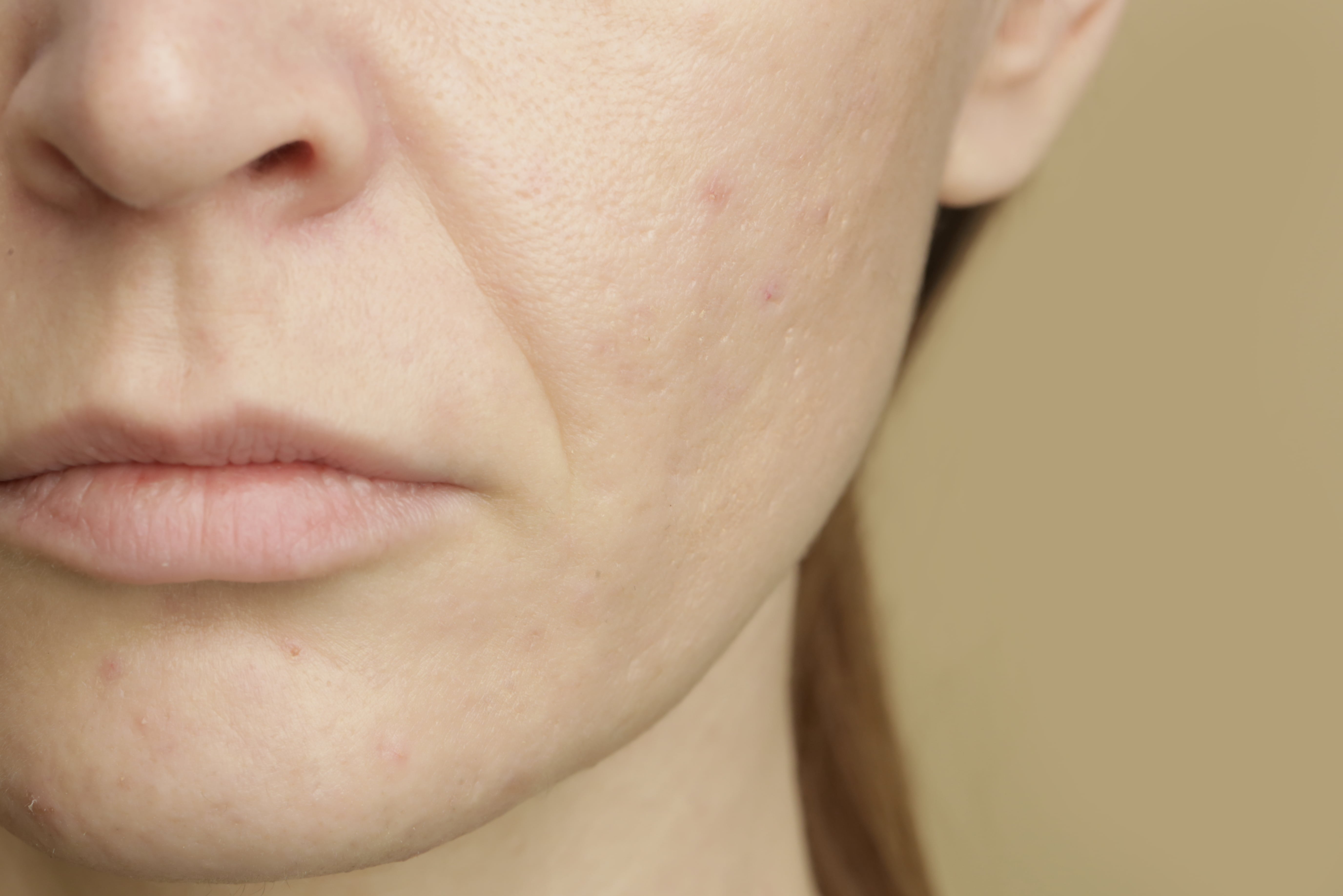 Enlarged Pores-min(2).jpg
