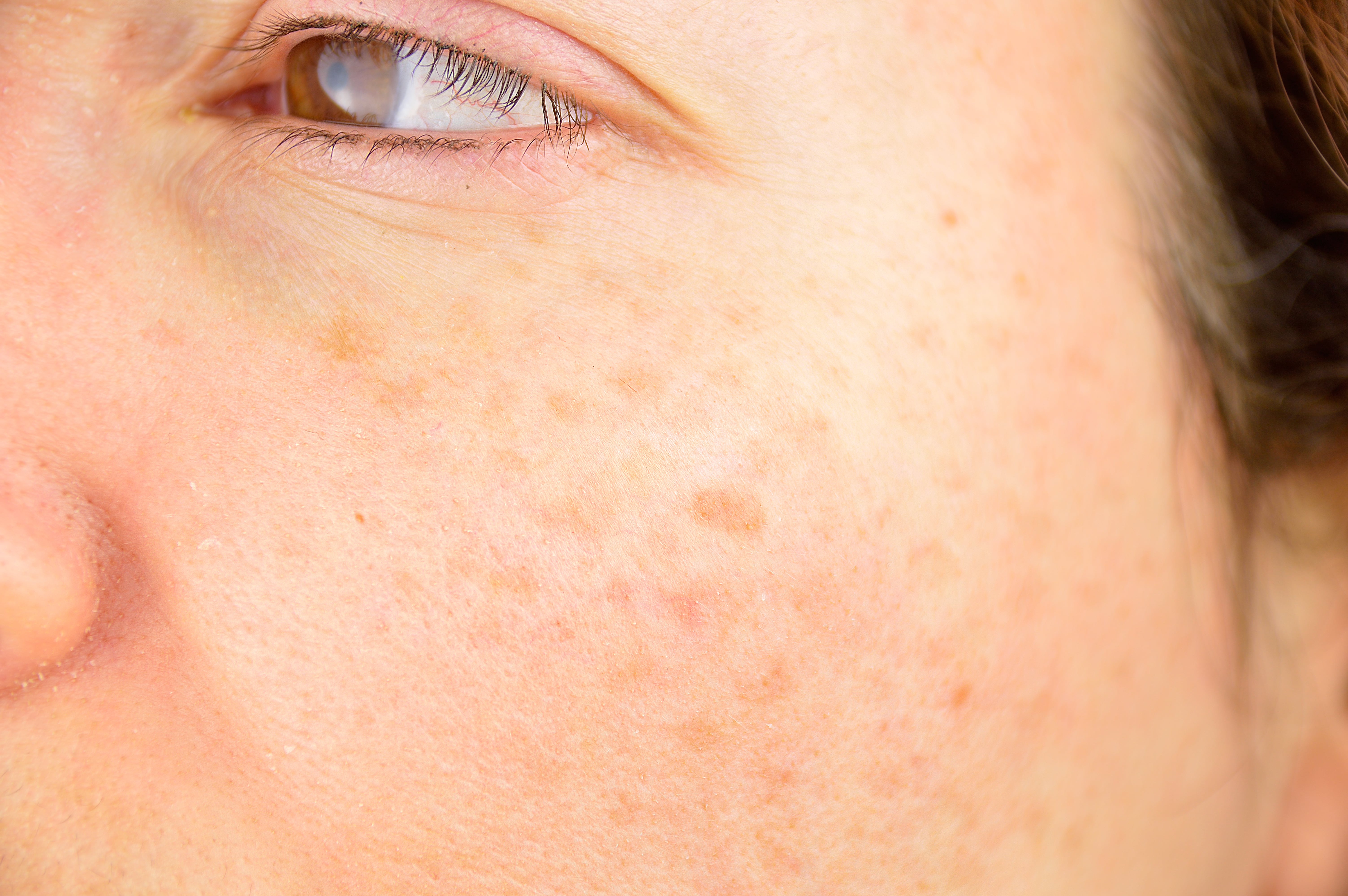 Pigmentation-min(2).jpg